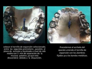 colocar el tornillo de expansión seleccionado.
entre las segundas premolares , paralela al
plano de oclusión y localizado a nivel de rafe
medio con 3 mm de separación de la
mucosa palatina ,ya que esta
descenderá debido a la disyunción.
Procedemos al acrilado del
aparato uniendo el tornillo de
expansión con los alambres
fijados ya a las bandas metálicas.
 