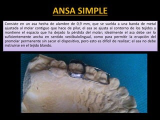 ANSA SIMPLE
Consiste en un asa hecha de alambre de 0,9 mm, que se suelda a una banda de metal
ajustada al molar contiguo que hace de pilar, el asa se ajusta al contorno de los tejidos y
mantiene el espacio que ha dejado la pérdida del molar; idealmente el asa debe ser lo
suficientemente ancha en sentido vestíbulolingual, como para permitir la erupción del
premolar permanente sin sacar el dispositivo, pero esto es difícil de realizar; el asa no debe
instruirse en el tejido blando.
 