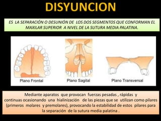 DISYUNCION
ES LA SEPARACIÓN O DESUNIÓN DE LOS DOS SEGMENTOS QUE CONFORMAN EL
MAXILAR SUPERIOR A NIVEL DE LA SUTURA MEDIA PALATINA.
Mediante aparatos que provocan fuerzas pesadas , rápidas y
continuas ocasionando una hialinización de las piezas que se utilizan como pilares
(primeros molares y premolares), provocando la estabilidad de estos pilares para
la separación de la sutura media palatina .
 
