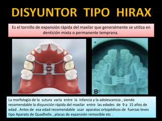 DISYUNTOR TIPO HIRAX
Es el tornillo de expansión rápida del maxilar que generalmente se utiliza en
dentición mixta o permanente temprana.
La morfología de la sutura varía entre la infancia y la adolescencia , siendo
recomendable la disyunción rápida del maxilar entre las edades de 9 a 15 años de
edad . Antes de esa edad recomendable usar aparatos ortopédicos de fuerzas leves
tipo Aparato de Quadhelix , placas de expansión removible etc .
 