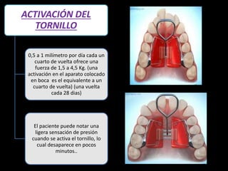 ACTIVACIÓN DEL
TORNILLO
0,5 a 1 milímetro por día cada un
cuarto de vuelta ofrece una
fuerza de 1,5 a 4,5 Kg. (una
activación en el aparato colocado
en boca es el equivalente a un
cuarto de vuelta) (una vuelta
cada 28 dias)
El paciente puede notar una
ligera sensación de presión
cuando se activa el tornillo, lo
cual desaparece en pocos
minutos..
 
