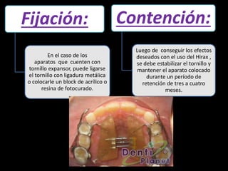 Fijación:
En el caso de los
aparatos que cuenten con
tornillo expansor, puede ligarse
el tornillo con ligadura metálica
o colocarle un block de acrílico o
resina de fotocurado.
Contención:
Luego de conseguir los efectos
deseados con el uso del Hirax ,
se debe estabilizar el tornillo y
mantener el aparato colocado
durante un período de
retención de tres a cuatro
meses.
 