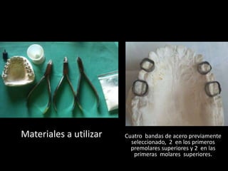 Cuatro bandas de acero previamente
seleccionado, 2 en los primeros
premolares superiores y 2 en las
primeras molares superiores.
Materiales a utilizar
 