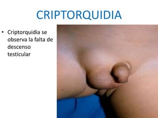 CRIPTORQUIDIA
• Criptorquidia se
observa la falta de
descenso
testicular
 