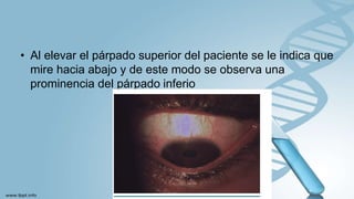 • Al elevar el párpado superior del paciente se le indica que
mire hacia abajo y de este modo se observa una
prominencia del párpado inferio
 