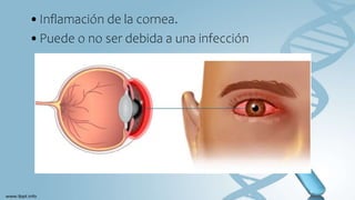 •Inflamación de la cornea.
•Puede o no ser debida a una infección
 