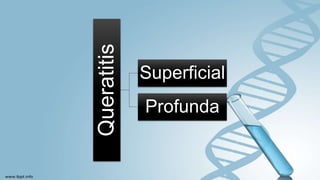 Queratitis
Superficial
Profunda
 