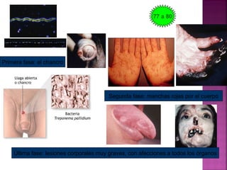 Treponema pallidum
Primera fase: el chancro
Segunda fase: manchas rojas por el cuerpo
Última fase: lesiones corporales muy graves, con afecciones a todos los órganos
77 a 80
 