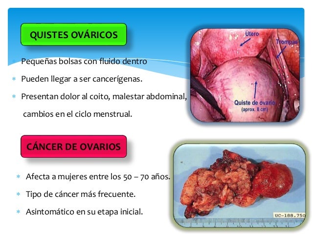 Aparato Reproductor Femenino, partes y enfermedades