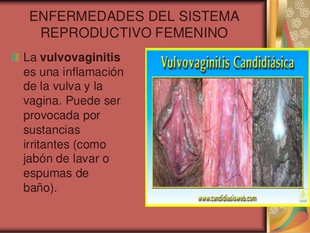 Como aumentar el espesor del miembro sin preparados