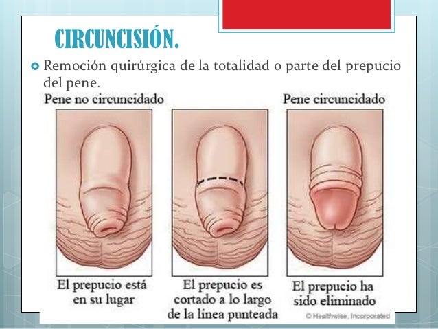 El aumento del miembro los actores