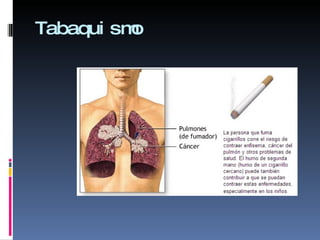 Tabaquismo 