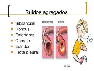Ruidos agregados Sibilancias Roncus Estertores Cornaje Estridor Frote pleural 