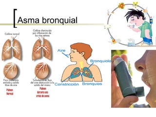 Asma bronquial 