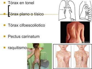 Tórax en tonel  Tórax plano o tísico Tórax cifoescoliotico  Pectus carinatum raquitismo 