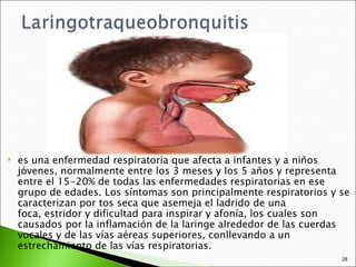    es una enfermedad respiratoria que afecta a infantes y a niños
    jóvenes, normalmente entre los 3 meses y los 5 años y representa
    entre el 15-20% de todas las enfermedades respiratorias en ese
    grupo de edades. Los síntomas son principalmente respiratorios y se
    caracterizan por tos seca que asemeja el ladrido de una
    foca, estridor y dificultad para inspirar y afonía, los cuales son
    causados por la inflamación de la laringe alrededor de las cuerdas
    vocales y de las vías aéreas superiores, conllevando a un
    estrechamiento de las vías respiratorias.
                                                                     28
 