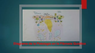 Diagrama de la Patología en la Fibrosis Quística 
 