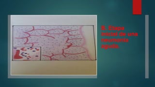 B. Etapa 
inicial de una 
neumonía 
aguda. 
 