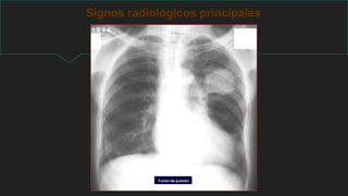 Signos radiológicos principales
Tumor de pulmón
 