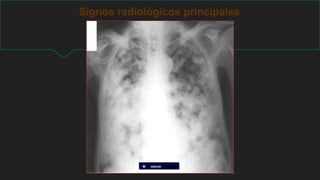 Signos radiológicos principales
MTS cáncer de mama
 