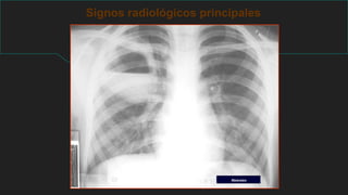 Signos radiológicos principales
Absceso
 