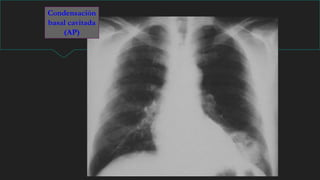 Condensación
basal cavitada
(AP)
 