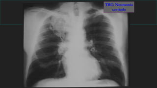 TBC: Neumonía
cavitada
 