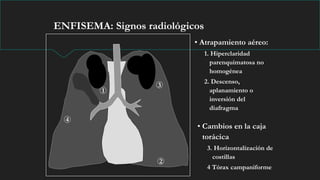 ENFISEMA: Signos radiológicos
• Atrapamiento aéreo:
1. Hiperclaridad
parenquimatosa no
homogénea
2. Descenso,
aplanamiento o
inversión del
diafragma
• Cambios en la caja
torácica
3. Horizontalización de
costillas
4 Tórax campaniforme
1
2
4
3
 