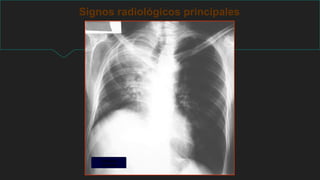 Signos radiológicos principales
Enfisema
vicariante
 
