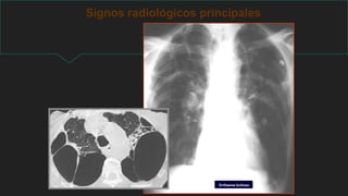 Signos radiológicos principales
Enfisema bulloso
 