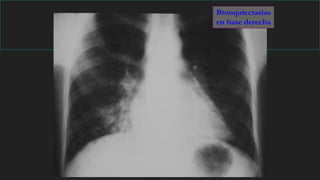 Bronquiectasias
en base derecha
 