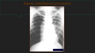 Signos radiológicos principales
Neumotórax
 