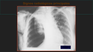 Signos radiológicos principales
Neumotórax a
tensión
 