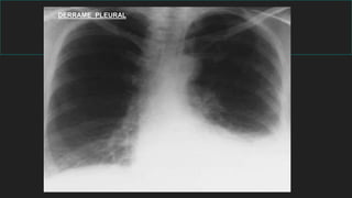 DERRAME PLEURAL
 