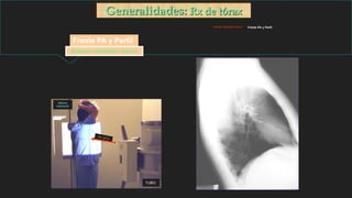 TUBO
Máxima
inspiración
Generalidades: Rx de tórax
Examen radiológico básico
Frente PA y Perfil
Examen radiológico básico Frente PA y Perfil
 