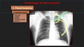 Radiología de tórax normal
1- Pared torácica
a- esqueleto torácico
Claviculas
Costillas
Escápula
Columna vertebral
Esternón
 