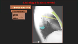Radiología de tórax normal
1- Pared torácica
a- esqueleto torácico
Costillas
Escápula
Columna vertebral
Esternón
 