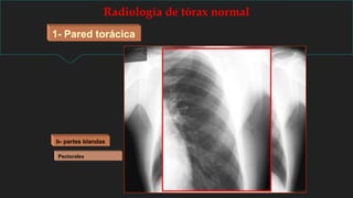 Radiología de tórax normal
1- Pared torácica
Pectorales
b- partes blandas
 