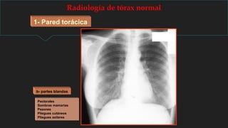 Radiología de tórax normal
1- Pared torácica
Pectorales
Sombras mamarias
Pezones
Pliegues cutáneos
Pliegues axilares
b- partes blandas
 