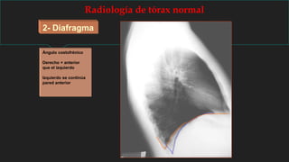 Radiología de tórax normal
2- Diafragma
Ángulo costofrénico
Derecho + anterior
que el izquierdo
Izquierdo se continúa
pared anterior
 