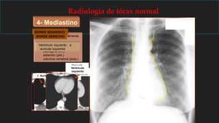 TVBI ASI
4- Mediastino
- Región situada centralmente
- Límites son:
opérculo torácico (sup.)
diafragma (inf.)
esternón (ant.)
columna vertebral (post.)
BORDE DERECHO
TVBD
VCS
Ao ascendente
VCS
TVBDAo ascendente
Aurícula derecha
Aurícula derecha
BORDE IZQUIERDO
TVBI Art.
Subclavia
Botón aórticoTronco de la arteria
pulmonar
Cayado
aórtico
Tronco de la
art. pulmonar
Orejuela de la
aurícula izquierda
Orejuela
aurícula
izquierda
Ventrículo izquierdo
Ventrículo
izquierdo
Radiología de tórax normal
 