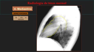 4- Mediastino
Radiología de tórax normal
BORDE ANTERIOR
Ventrículo derechoTronco de la arteria
pulmonar
AortaAurícula izquierdaVCI
BORDE POSTERIOR
 