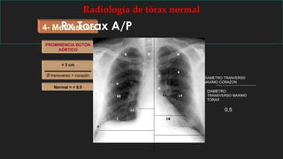 4- Mediastino
Radiología de tórax normal
ÍNDICE
CARDIOTORÁCICO
Ǿ transverso > tórax
Ǿ transverso > corazón
Normal = < 0,5
PROMINENCIA BOTÓN
AÓRTICO
< 3 cm
Rx Torax A/P
0,5
DIAMETRO TRANVERSO
MAXIMO CORAZON
DIAMETRO
TRANSVERSO MAXIMO
TORAX
 