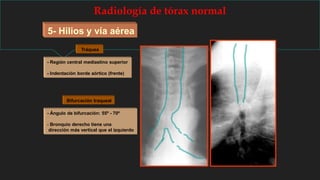 Radiología de tórax normal
5- Hilios y vía aérea
Tráquea
- Región central mediastino superior
- Indentación borde aórtico (frente)
Bifurcación traqueal
- Ángulo de bifurcación: 55º - 70º
- Bronquio derecho tiene una
dirección más vertical que el izquierdo
 