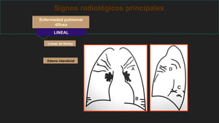 Signos radiológicos principales
Enfermedad pulmonar
difusa
LINEAL
Líneas de Kerley
Edema intersticial
 