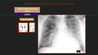 Signos radiológicos principales
Enfermedad pulmonar
difusa
LINEAL
Líneas de Kerley
ICC
 