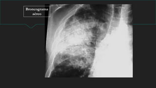 Broncograma
aéreo
 