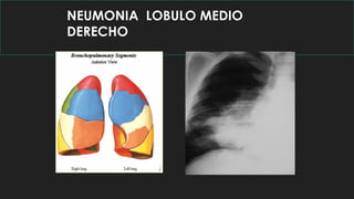 NEUMONIA LOBULO MEDIO
DERECHO
 