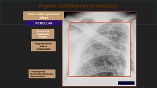 Signos radiológicos principales
Enfermedad pulmonar
difusa
RETICULAR
Fina red de
opacidades
lineales
Engrosamiento
inter e
intralobulillar
Colagenopatías
Neumonitis intersticiales
Neumoconiosis
Colagenopatía
 
