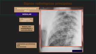 Signos radiológicos principales
Enfermedad pulmonar
difusa
NODULAR
Pequeños
nódulos < 3 mm
Nódulos inter,
intralobulillares o
centrolobulillares
TBC miliar
Enfermedades granulomatosas
MTS
Neumoconiosis
 
